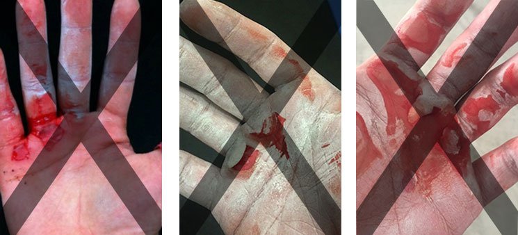 Ripped and bloody hands before using The Natural Grip